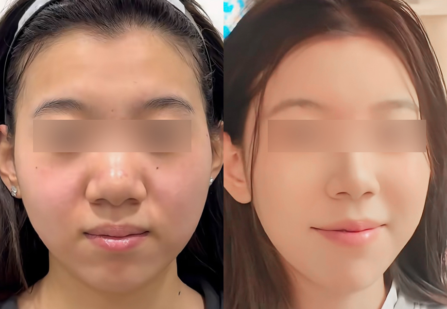 전후사진