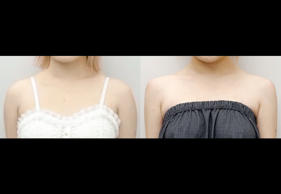 전후사진