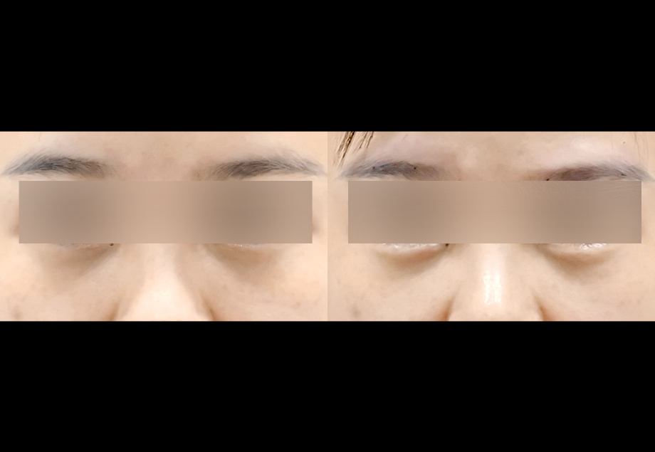 전후사진
